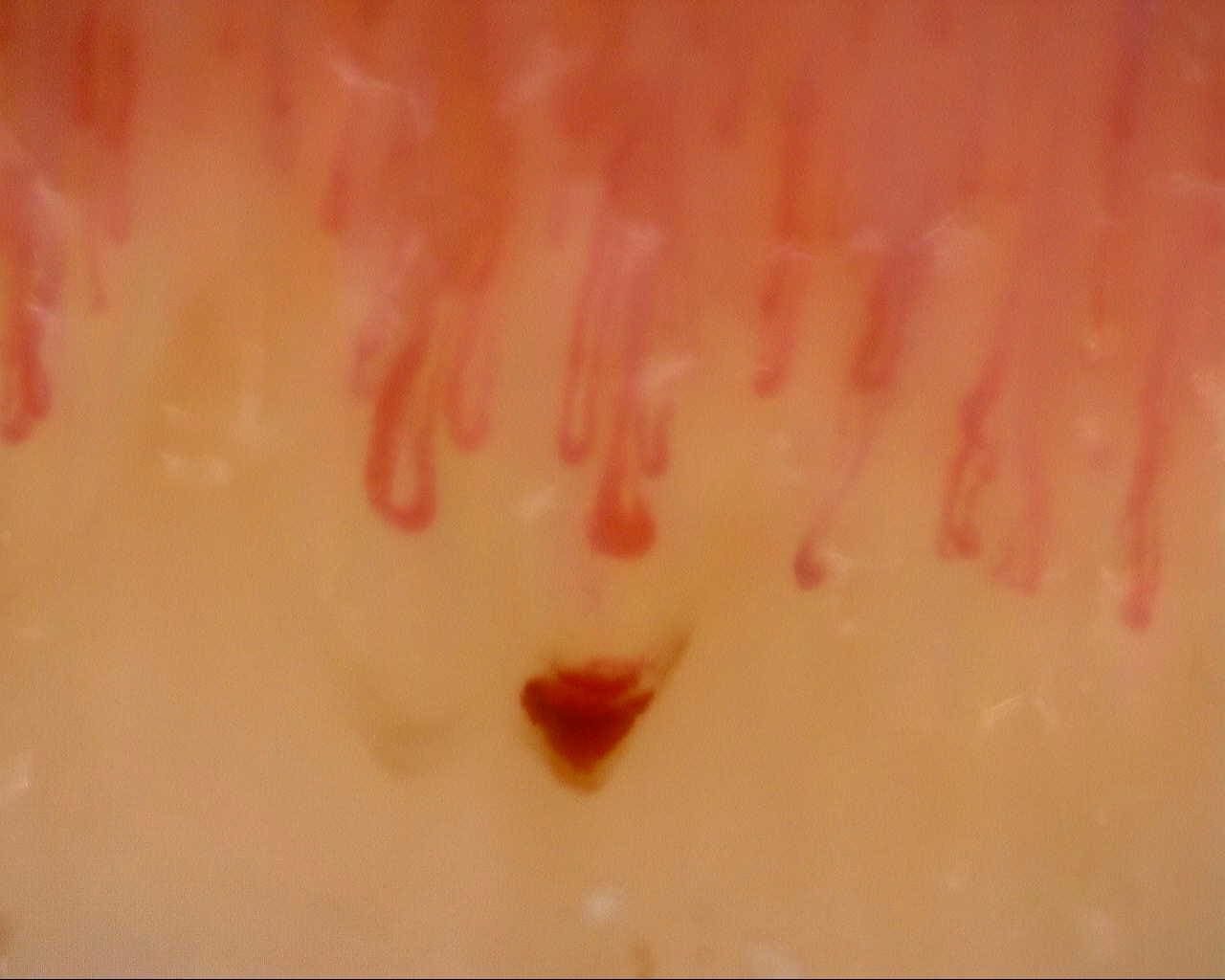 Capillaroscopy example with Dino-Lite