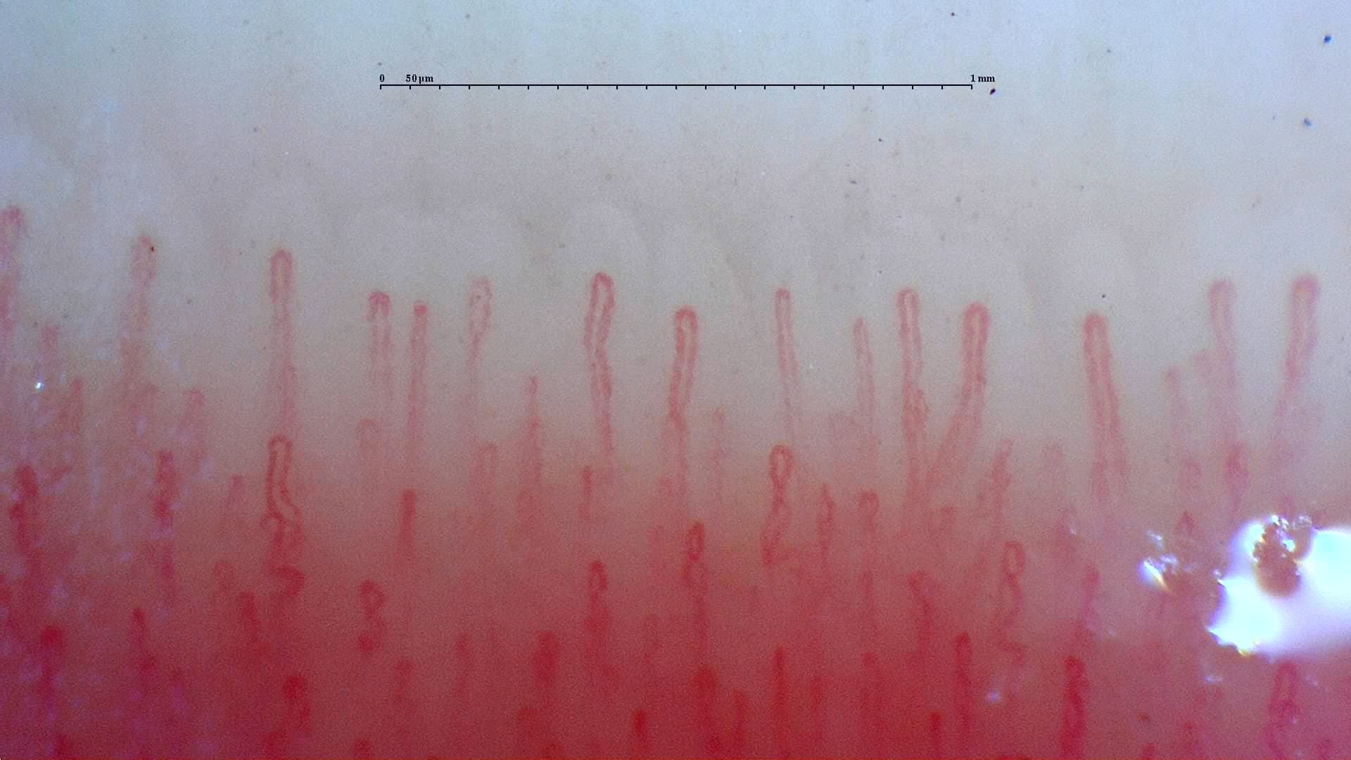Nailfold detail with Smart G-Scope